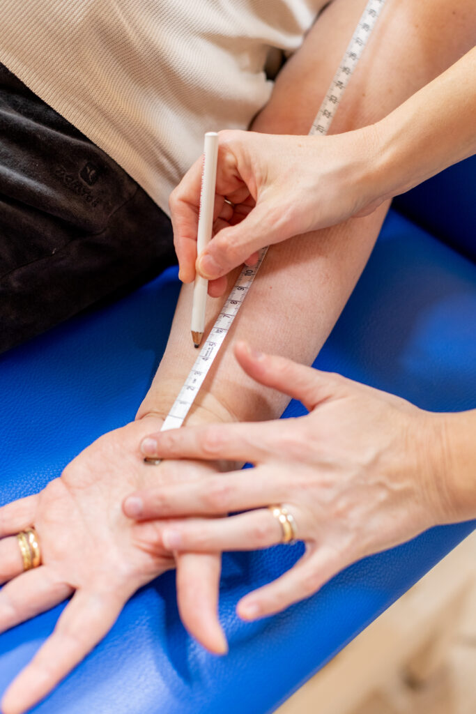 fisioterapista misura il braccio di una paziente con linfedema per preparare bendaggio