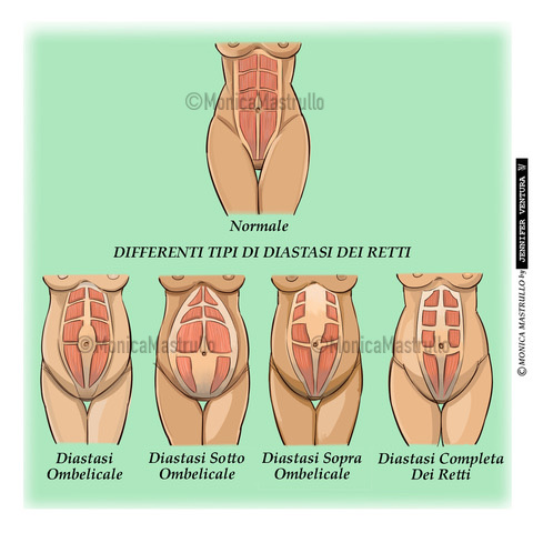 diastasi addominale