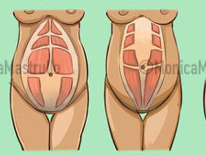 Diastasi addominale e ginnastica ipopressiva