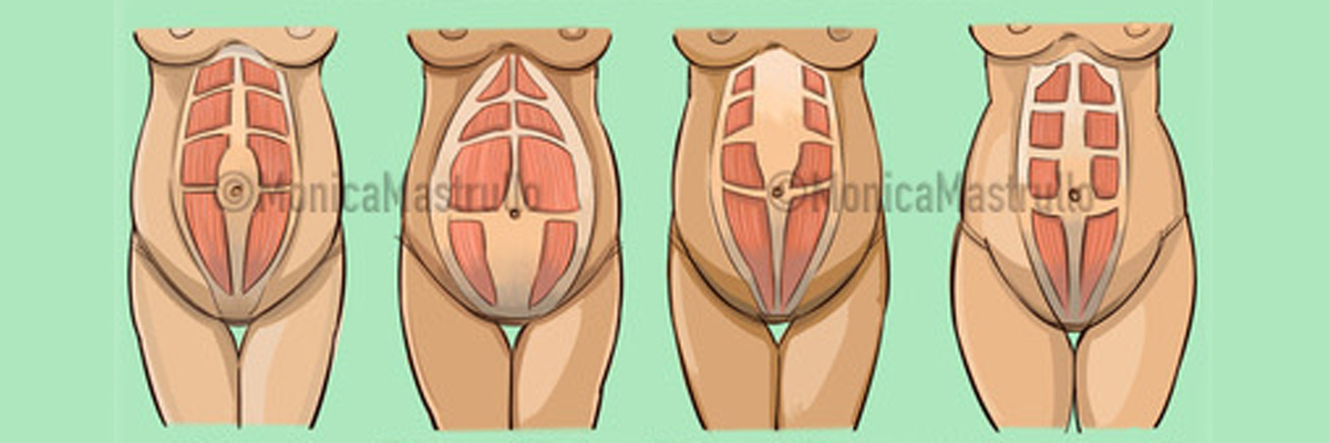 Diastasi addominale e ginnastica ipopressiva